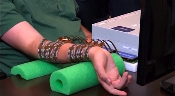 Neurobridge-technology-Ohio-State-Wexner-Medical-Center-Battelle-paralysis-quadriplegic-electrode-stimulation-movement-arm-EDIWeekly